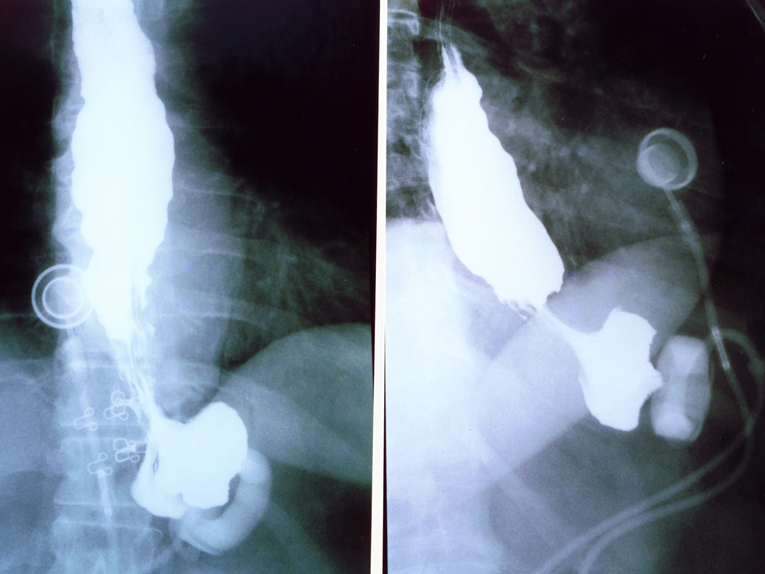 GASTRIC BANDING