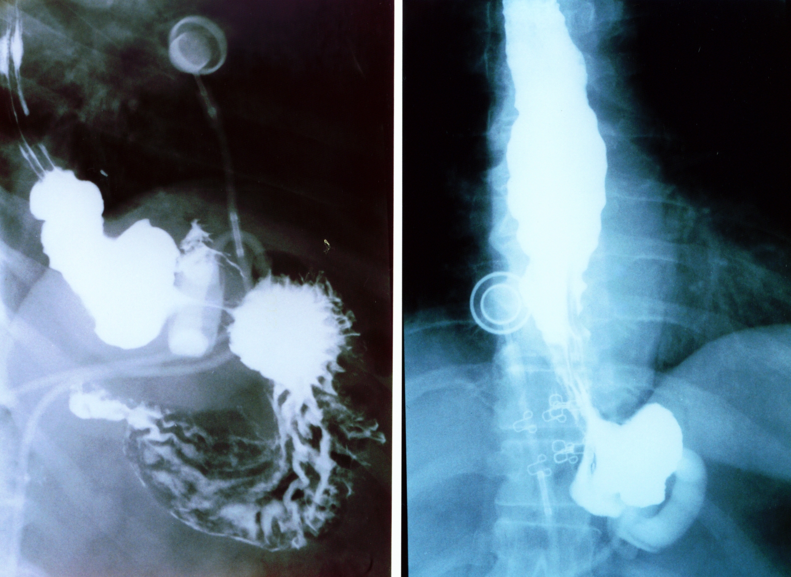 GASTRIC BANDING