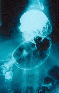 GASTRIC VOLVULUS