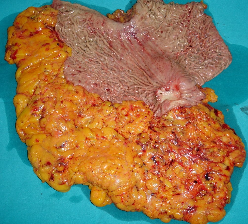 SCIRRHOUS GASTRIC CANCER