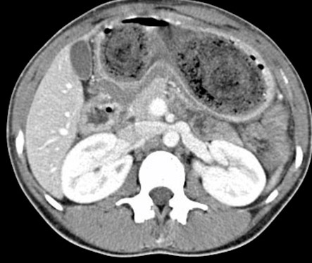 GASTRIC TRICHOBEZOAR