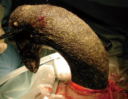 GASTRIC TRICHOBEZOAR