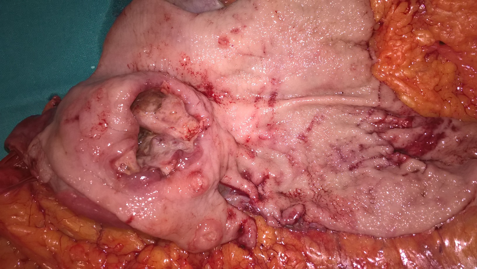 GASTRIC CANCER