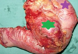 DUODENAL SOMATOSTATINOMA