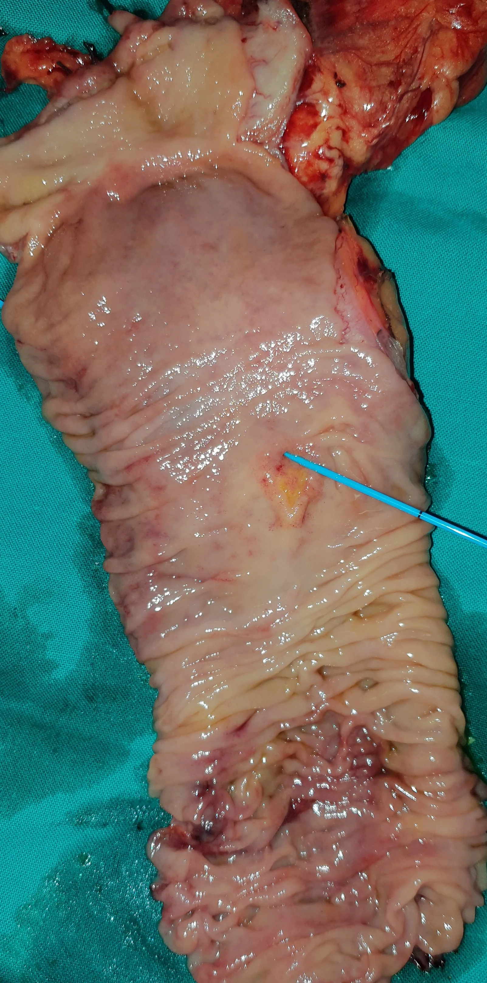 AMPULLA VATER CARCINOMA