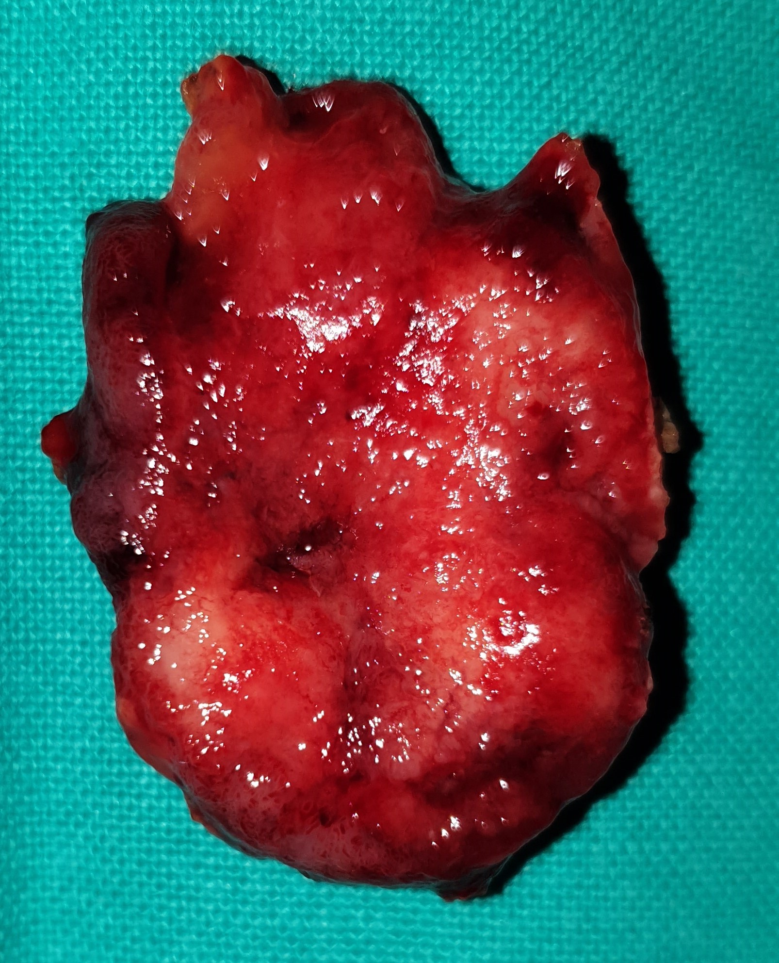 PAPILLECTOMY