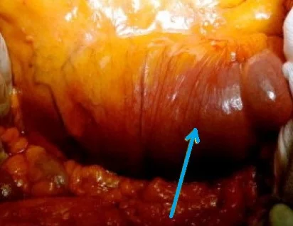 MALIGNANT DUODENAL HISTIOCYTOMA