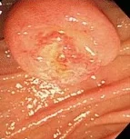AMPULLA VATER TUMOR