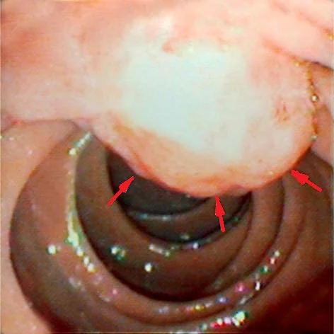 AMPULLA VATER TUMOR