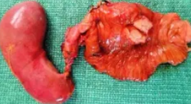 AMPULLARY ADENOCARCINOMA