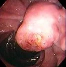 AMPULLA VATER CARCINOMA