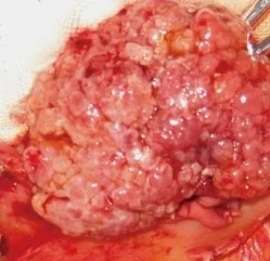 AMPULLARY TUMOR
