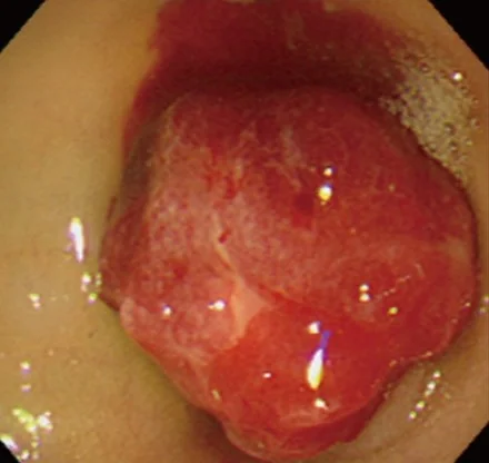 BLEEDING DUODENAL HAEMANGIOMA