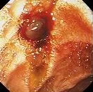 BLEEDING DUODENAL ULCER