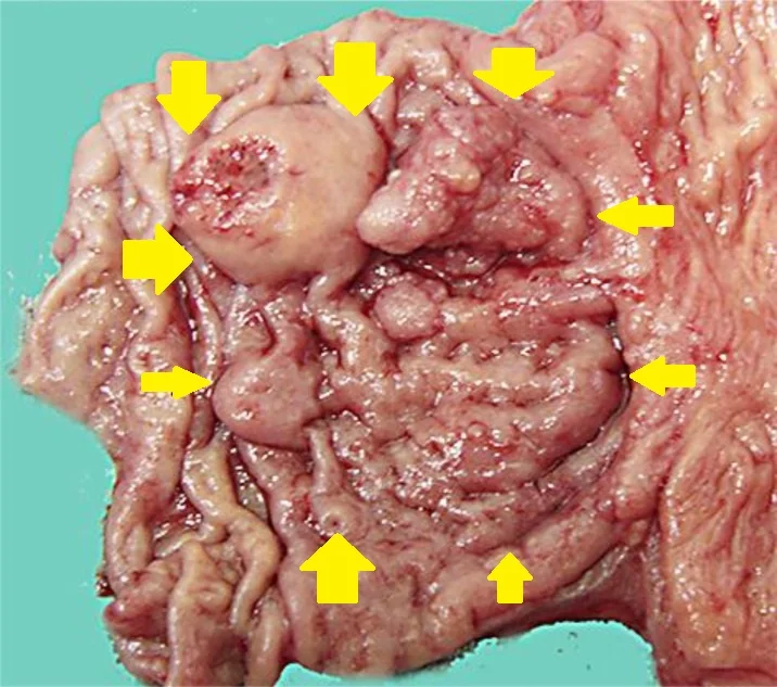 DUODENAL ADENOCARCINOMA