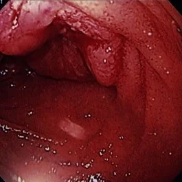 DUODENAL ADENOCARCINOMA