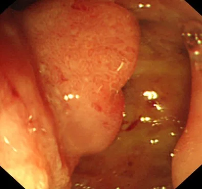 DUODENAL ADENOCARCINOMA