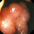 DUODENAL ADENOMA