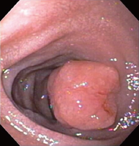 DUODENAL AMYLOIDOMA