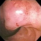 DUODENAL CARCINOMA