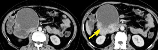 DUODENAL CYST