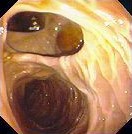 DUODENAL DIVERTICULUM