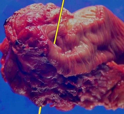 DUODENAL GIST RUPTURE