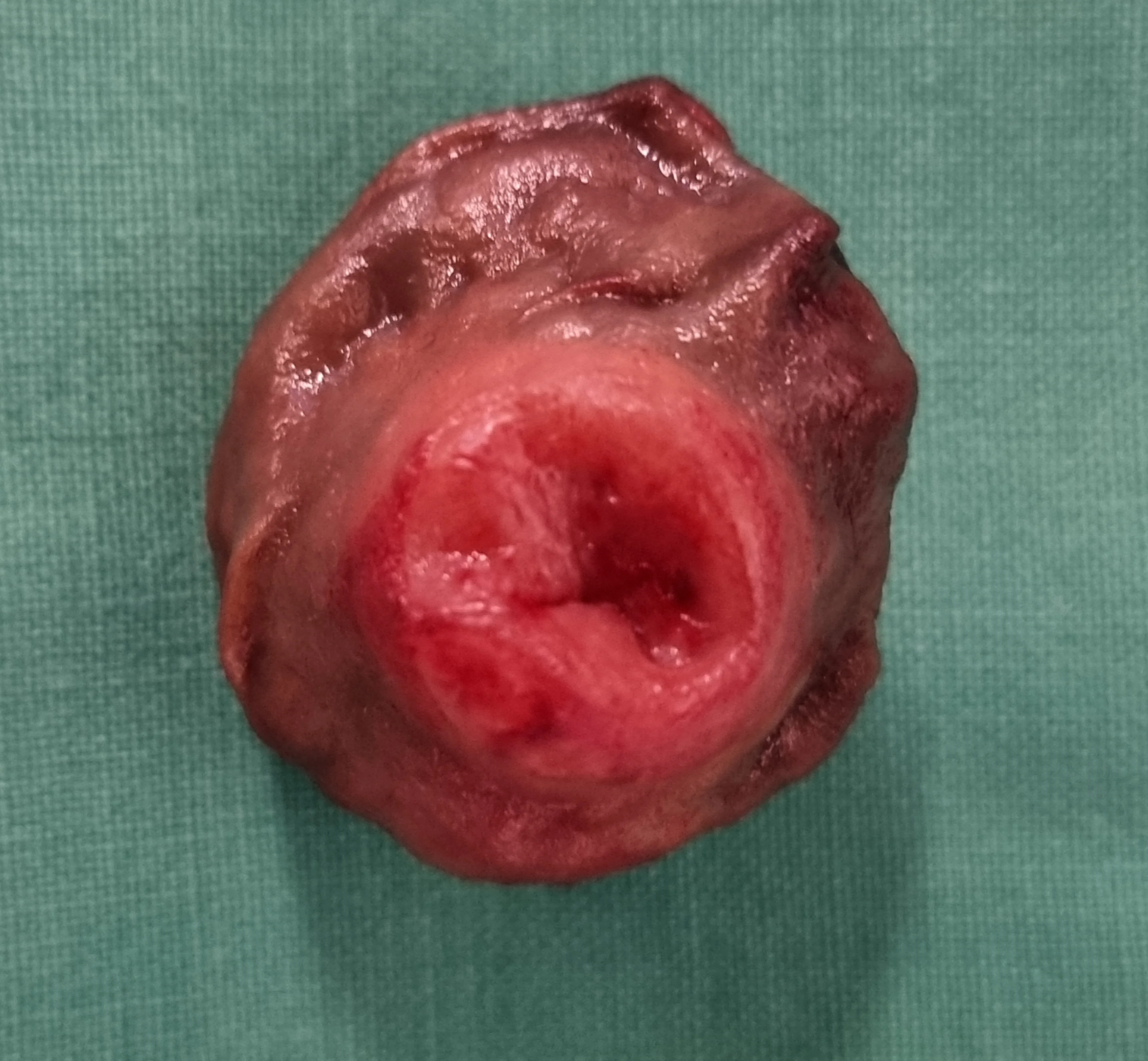 DUODENAL GIST