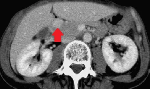 DUODENAL GIST