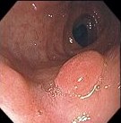 HYPERPLASTIC DUODENAL POLYP