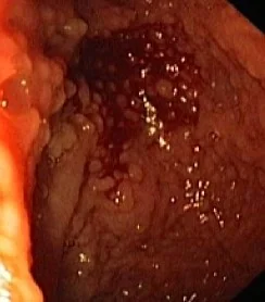 DUODENAL INFLAMMATORY POLYPS