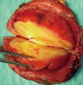 SIZEABLE DUODENAL INFLAMMATORY POLYP