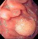 DUODENAL LYMPHANGIECTASIA
