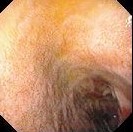 DUODENAL LYMPHOID HYPERPLASIA