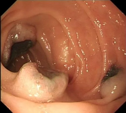 METASTATIC DUODENAL MELANOMA