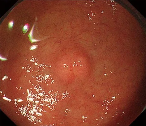 DUODENAL NET