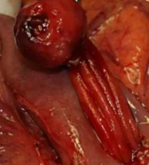 DUODENAL PARAGANGLIOMA