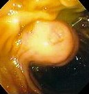 DUODENAL PARAGANGLIOMA