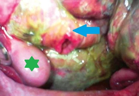 DUODENAL PERFORATION