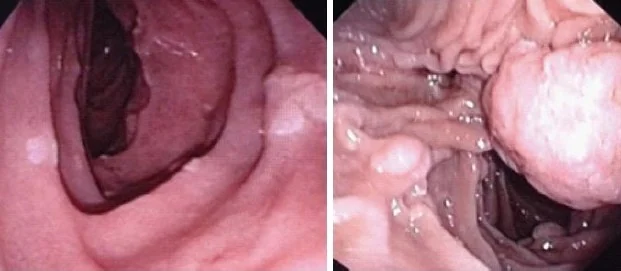 DUODENAL FAP