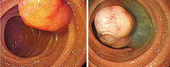 DUODENAL POLYPOSIS