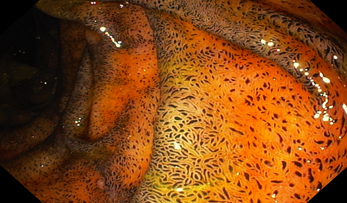 DUODENAL PSEUDOMELANOSIS