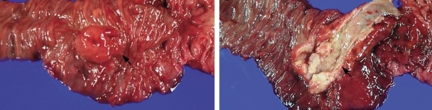 DUODENAL SOMATOSTATINOMA