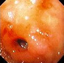 DUODENAL STRICTURE 