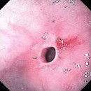 DUODENAL STRICTURE