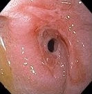 DUODENAL STRICTURE