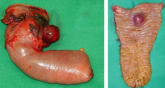 DUODENAL TUMOR