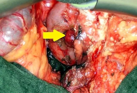 DUODENAL TUMOR