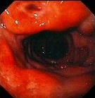 DUODENAL ULCER