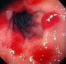 DUODENITIS